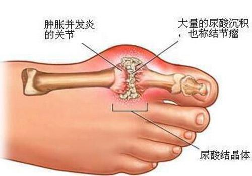 痛风用什么泡脚最好（痛风用什么泡脚最好,用小苏打水泡痛风处好吗）