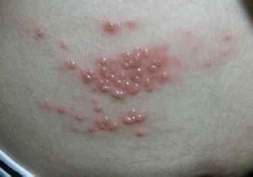 得湿疹多喝水还是少喝水 湿疹喝水多好吗