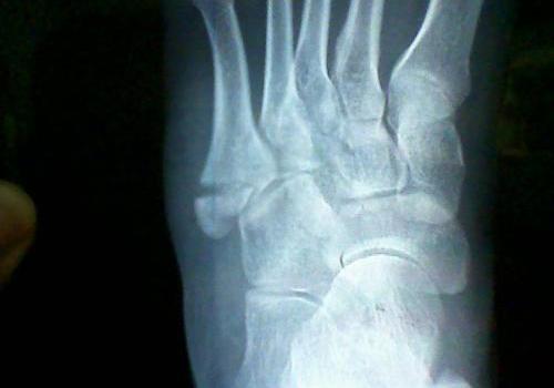 骨折一个月为什么还肿(骨折一个月了还肿是什么原因)