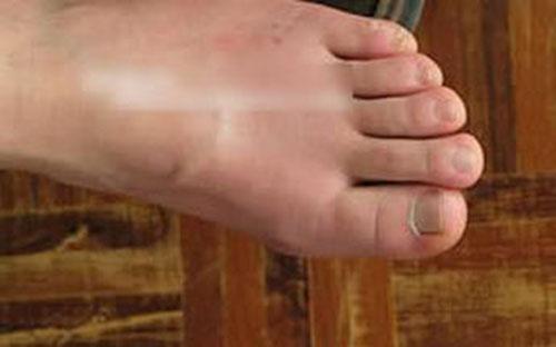 痛风有什么症状 痛风有什么症状反应