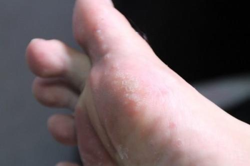 脚气怎么治(脚气怎么治疗能除根)