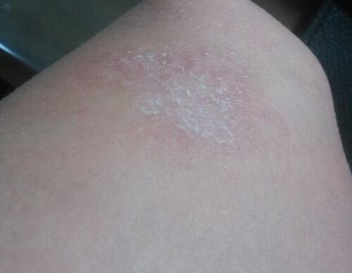 您需要警惕的银屑病并发症（警惕银屑病有四大并发症）