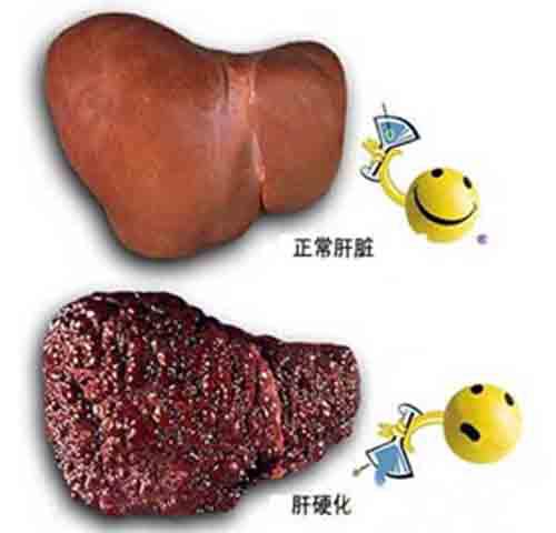 肝硬化的临床表现有哪些 肝硬化的临床表现有哪些?简答题