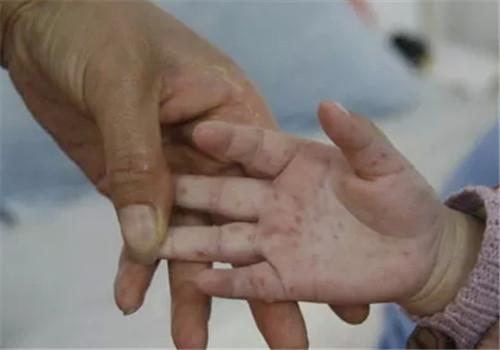 手足口病是怎么引起的（手足口病是怎么引起的好了之后还会发吗）