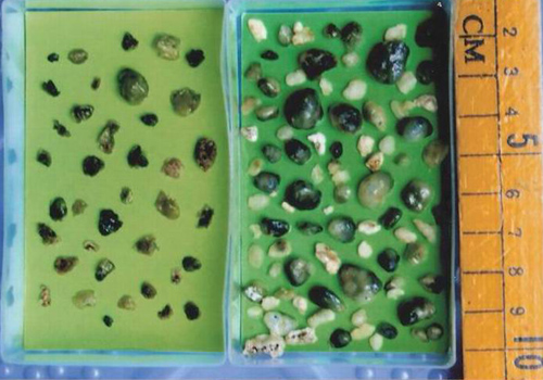 胆结石最佳治疗方法 胆结石治疗方法