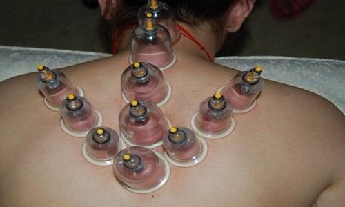 肩部拔罐位置与功效图 肩部拔罐位置示意图