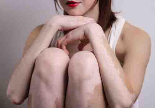 白癜风初期白班特点 自癜风初期白斑特点