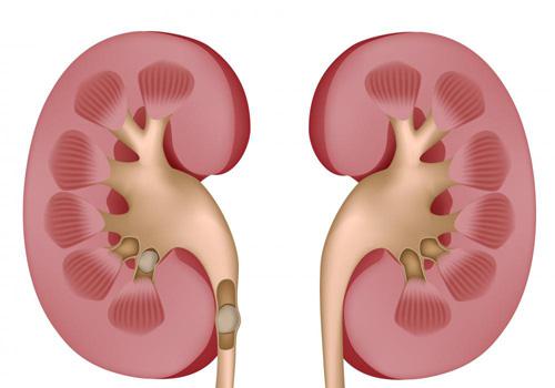 肾结石要注意什么 为什么会得肾结石要注意什么