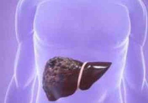 肝硬化晚期能活多久(酒精性肝硬化晚期能活多久)