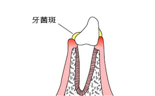 牙周炎是什么原因引起的（经常牙周炎是什么原因引起的）