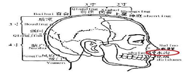 水沟的针刺方法 水沟针灸视频