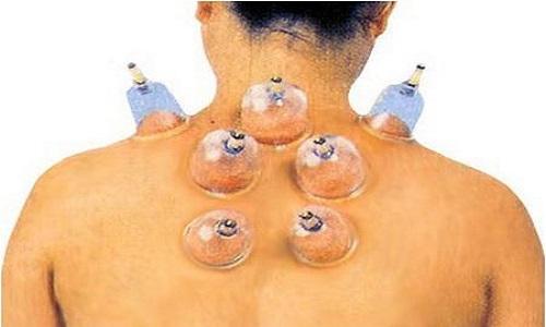 带状疱疹拔罐效果好吗 带状疱疹拔罐好得快吗