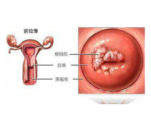 hpv病毒是什么 hpv病毒是什么病毒?如何感染的