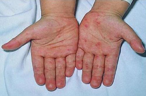 手足口病初期症状 手足口病初期症状与治疗