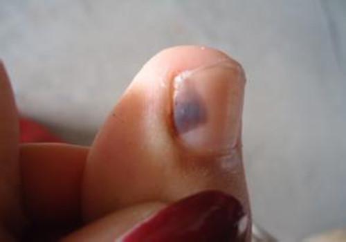 打球脚趾甲淤血怎么办 打球脚趾甲经常淤血怎么办