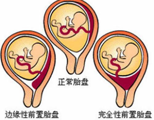 前置胎盘是怎样造成的（什么原因造成前置胎盘）