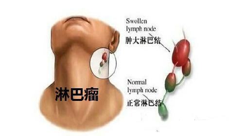 肺癌究竟是如何转移的（什么癌症会转移到肺）