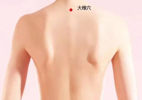 发烧拔罐拔哪个位置图 发烧拔罐位置图