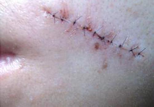 拆线晚了有什么影响