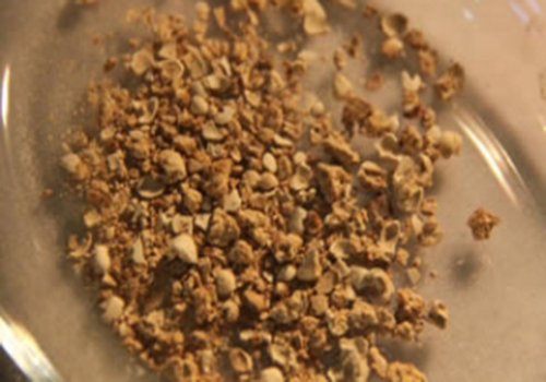 肾结石怎么治最好（肾结石引起的肾积水怎么治疗）