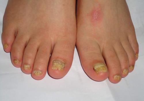 灰指甲是怎么引起的（为什么会灰指甲）