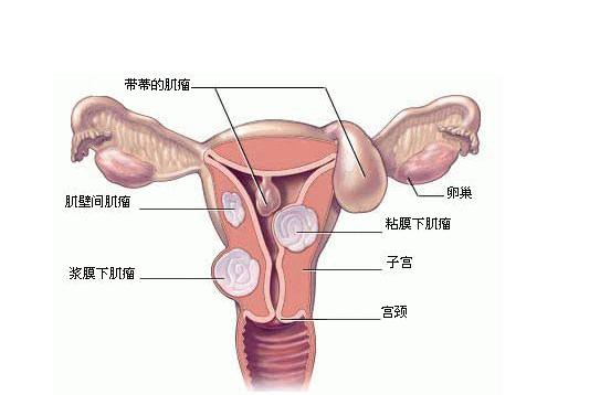 子宫肌瘤常见并发症（子宫肌瘤潜在并发症有哪些）