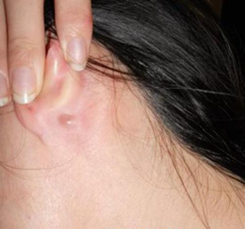 耳朵后面长了个硬包（耳朵后面长了个硬包是什么原因）
