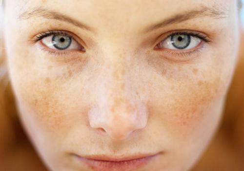 银屑病是什么原因引起的 银屑病是什么原因引起的?