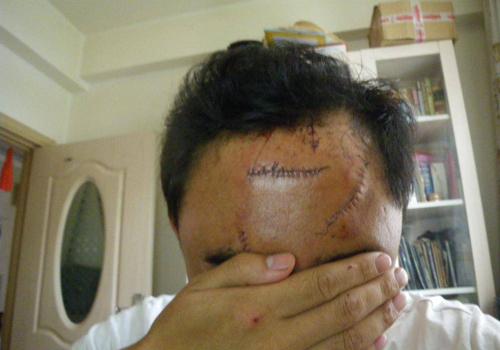 拆线可以自己拆吗（伤口拆线可以自己拆吗）