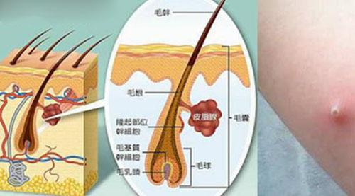 为什么会得毛囊炎 为什么会长毛囊炎怎么引起的