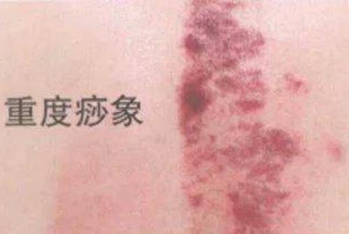 刮痧后第二天背部很痛 刮痧后第二天背部很痛如何缓解