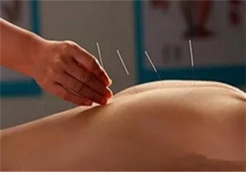 针灸减肥效果好吗 针灸减肥效果好吗疼吗