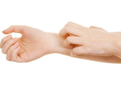 荨麻疹有哪些症状表现（荨麻疹有什么表现）