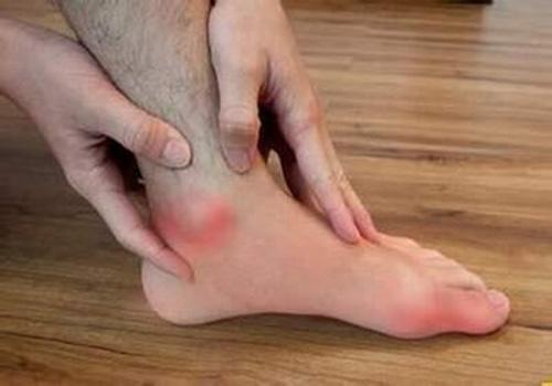 痛风会引起哪些并发症 痛风会引起哪些并发症百度百科