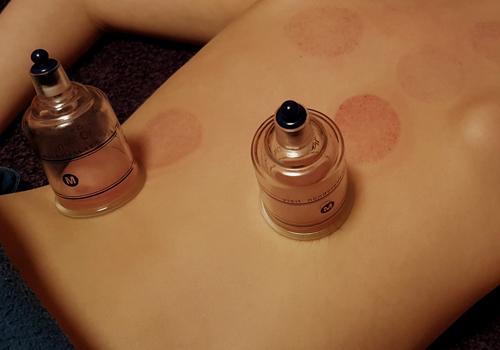 冬天可以拔罐吗（冬天可以拔罐么）