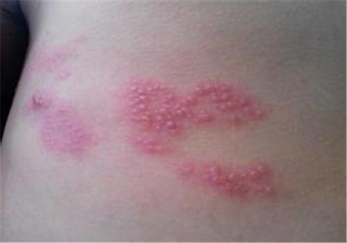 带状疱疹好了还会复发吗（带状疱疹治愈以后还会复发吗）