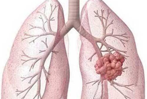 肺结核痊愈后和正常人一样吗 肺结核治愈后和正常人一样吗,体检表上会不会不一样