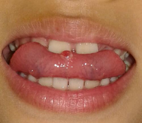 舌头起血泡是什么原因 舌头起血泡是什么原因引起的图片