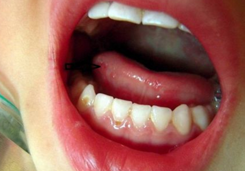 手足口病先从哪里开始（手足口病是哪里先开始）