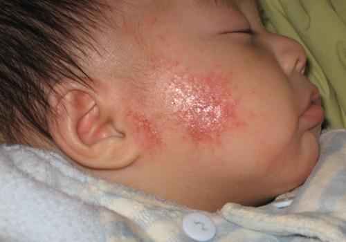 冬天脸上湿疹反反复复怎么办（冬天宝宝脸上湿疹反复怎么办）