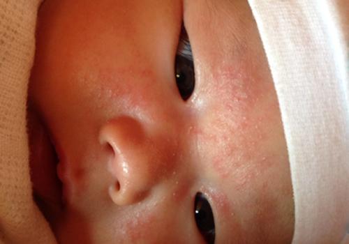 宝宝湿疹起皮是不是快好了 宝宝湿疹快好了是不是会脱皮