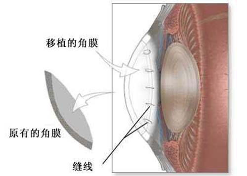 眼角膜是什么 眼角膜是什么东西