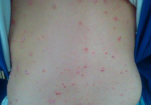 银屑病分为哪几种类型（银屑病分为哪几种类型图片）