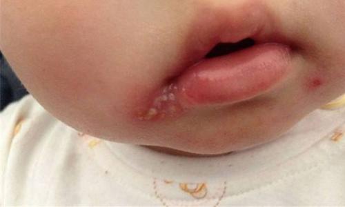 嘴唇上长泡可以涂牙膏吗 嘴唇上长泡能涂牙膏吗