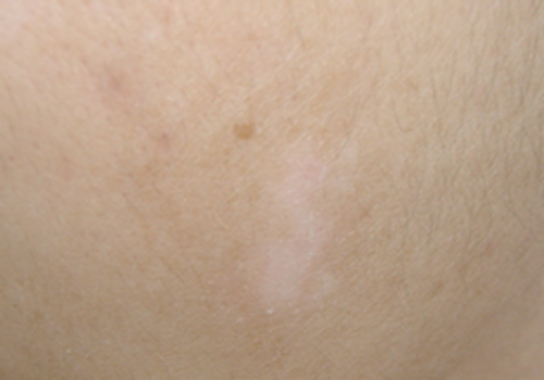 白癜风可以彻底治好吗()