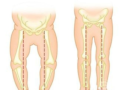 婴儿O型腿如何判断 婴儿是不是o型腿怎么判断