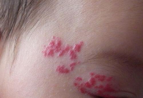 血管瘤吃什么好 肝右叶血管瘤吃什么好