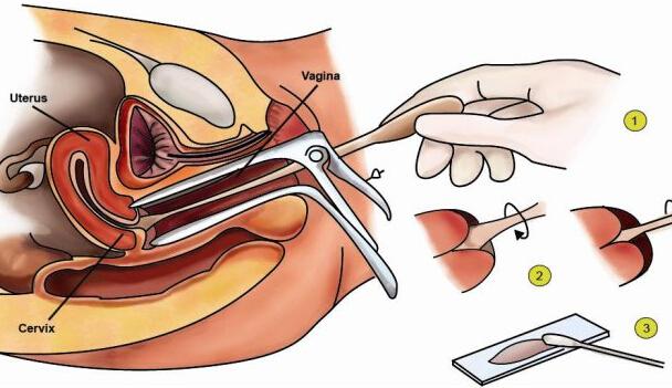 谈宫颈癌预防和HPV疫苗 宫颈癌疫苗与HPV