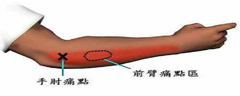 网球肘艾灸要哪个位置 网球肘艾灸部位