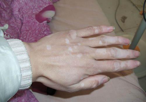 白癜风会不会传染